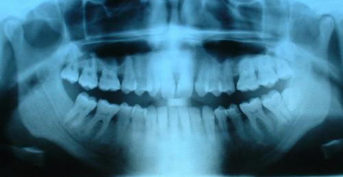 Czym jest nadwrażliwość zębiny